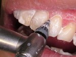 歯石の除去の治療費用について