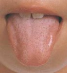 舌炎や地図状舌で舌の表面が荒れているのかもしれません