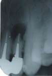 歯根嚢胞や急性根尖性歯周炎が考えられます。