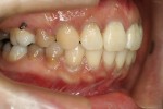 出っ歯の治療