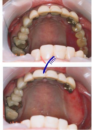 顎関節症とインプラント＆入れ歯について