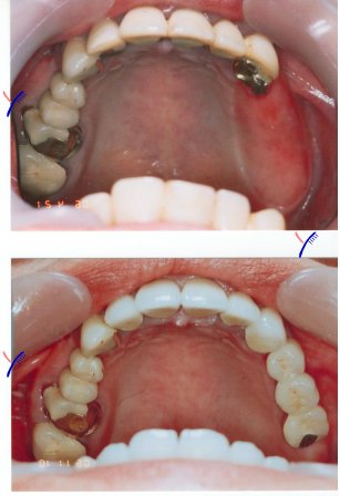 顎関節症とインプラント＆入れ歯について