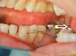 歯周病に歯列矯正とインプラント