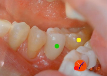 歯周病に歯列矯正とインプラント