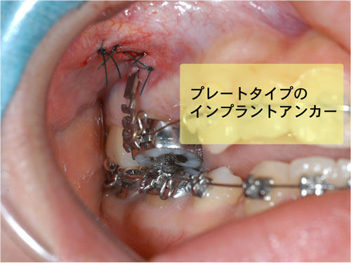 歯列矯正に用いるインプラントアンカーについて