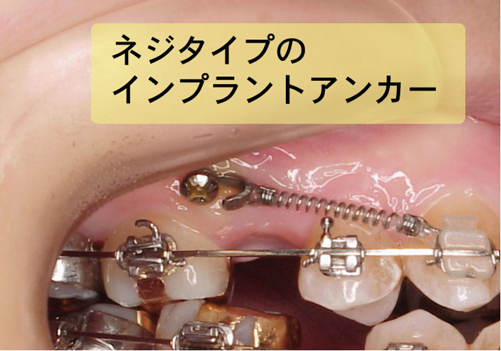 歯列矯正に用いるインプラントアンカーについて