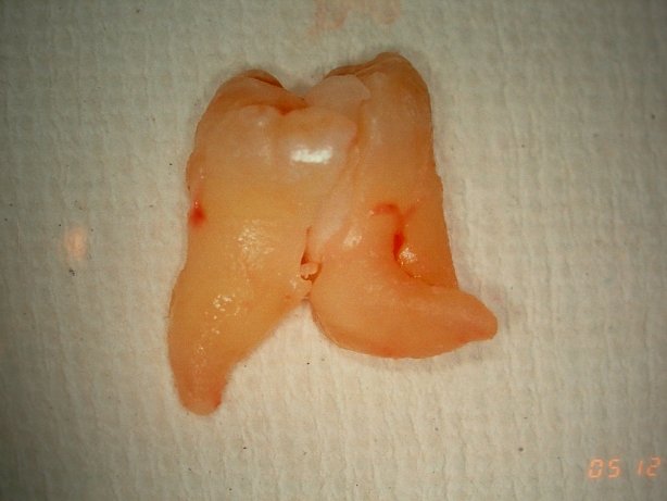 抜歯、インプラント外科について