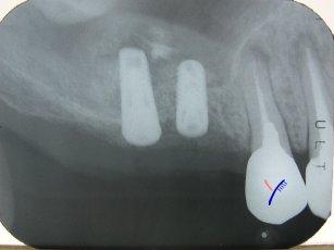 歯科レントゲンの診断について
