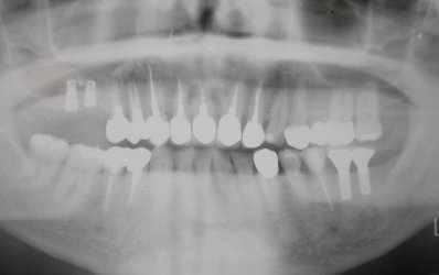 歯科レントゲンの診断について