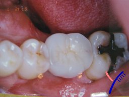 最後臼歯7番の保存or抜歯