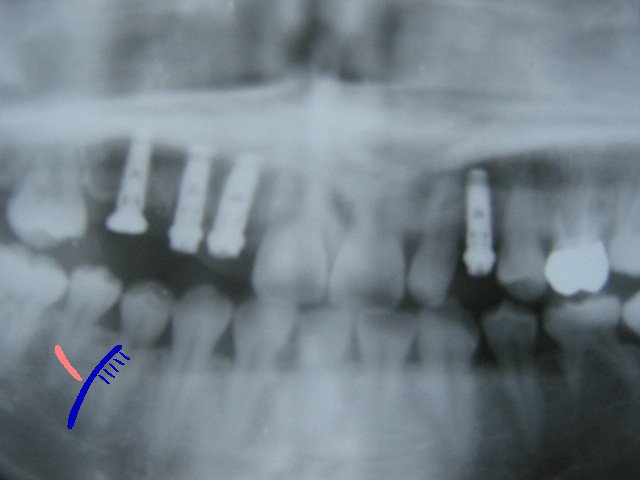 乳歯の後の後継永久歯欠如についてです。