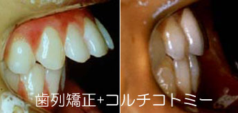 出っ歯を矯正で治す治療法