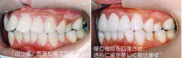 出っ歯を矯正で治す治療法