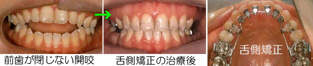 開咬の症例の多くは歯列矯正治療で治す事が出来ます。