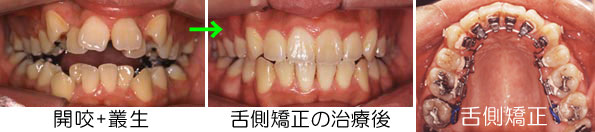 開咬の症例の多くは歯列矯正治療で治す事が出来ます。