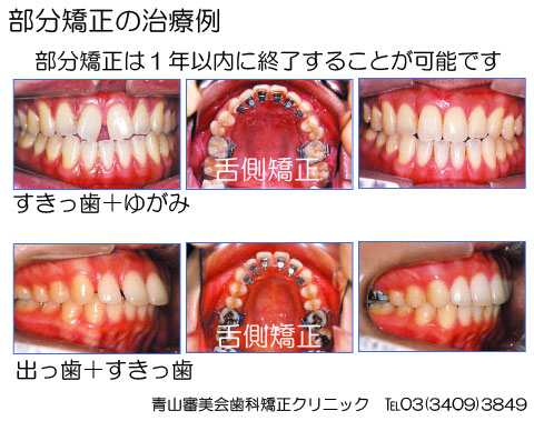 前歯だけの部分的な歯列矯正