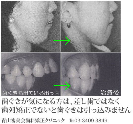 出っ歯と歯ぐきが気になる場合の矯正方法