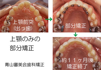 歯列矯正の方法