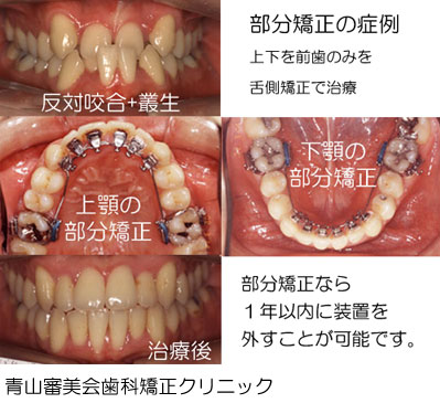 歯列矯正の方法