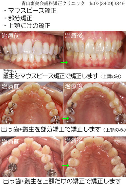 部分矯正は、前歯6本の範囲で矯正可能な症例です。