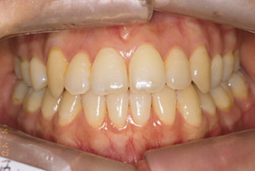 八重歯の治療法には3種類あります。(歯列矯正)