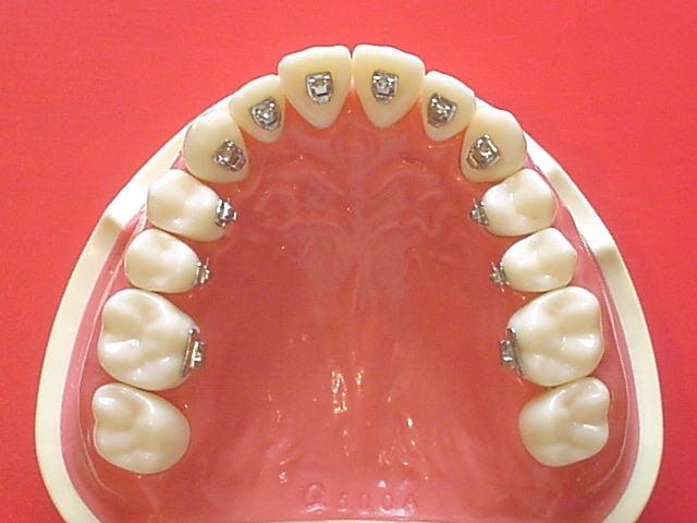 叢生と八重歯の矯正について。