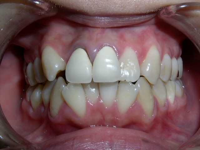 歯ぐきの黒さ。