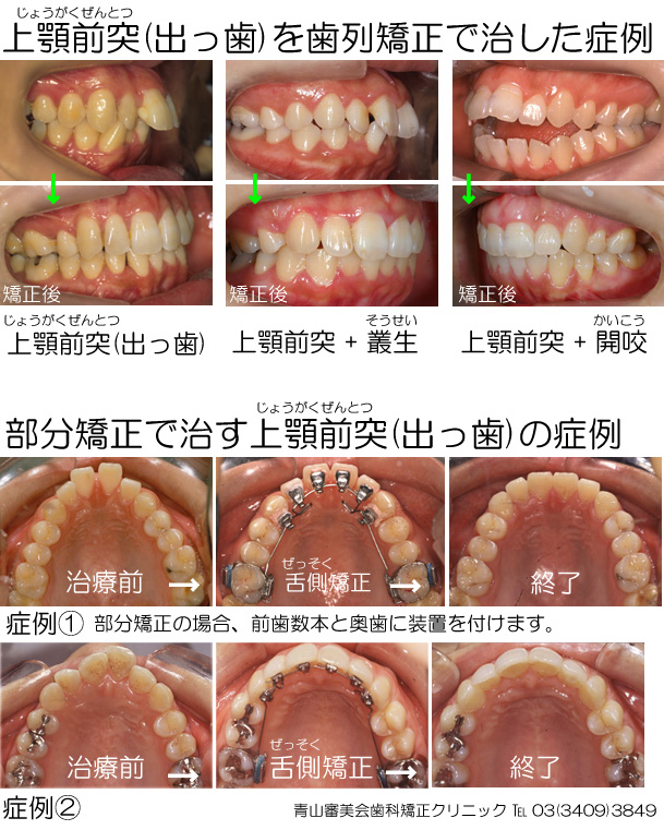 出っ歯の原因は原則として遺伝的(先天的)要因が主要