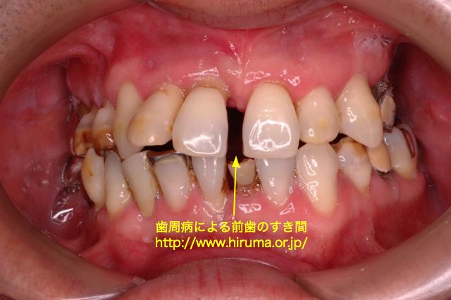 歯周病による空隙歯列の可能性