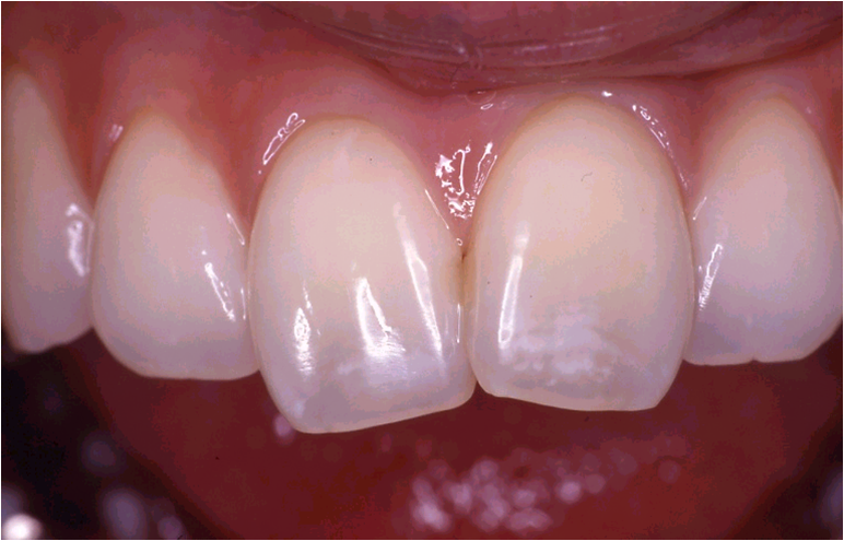 差し歯の際の神経治療