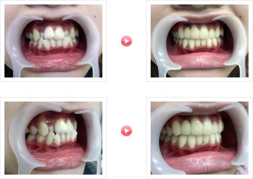 「歯並び」でお悩みの患者様の治療例-02