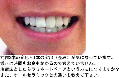 前歯の変色と1本の突出、歪みが気になりラミネートベニア
