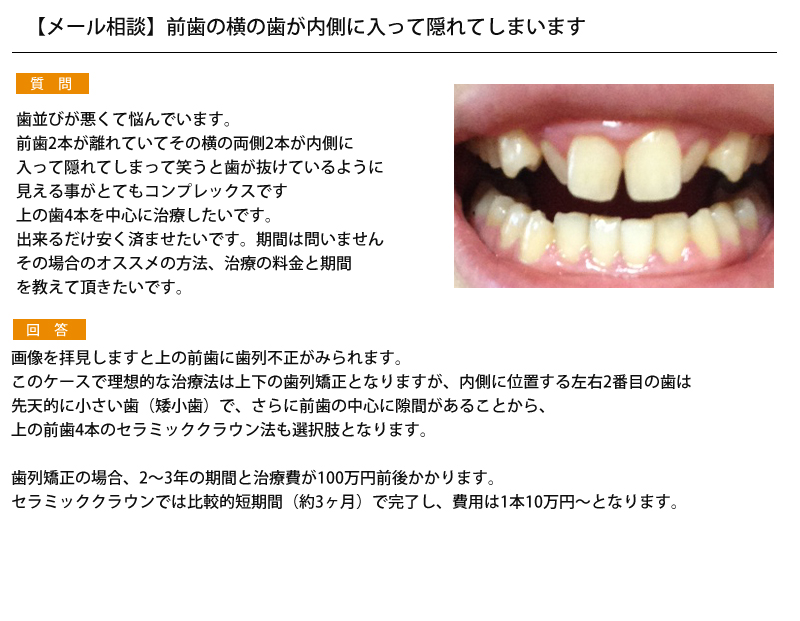 (写真)前歯の横の歯が内側に入って隠れてしまいます 矯正方法・費用 専門家プロファイル (写真)前歯の横の歯が内側に入って隠れてしまいます 矯正方法・費用 専門家プロファイル