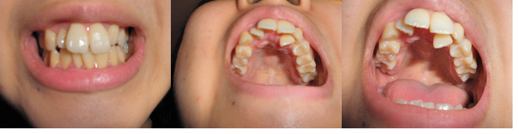 私の歯は前歯の裏に歯があり、短期間で直