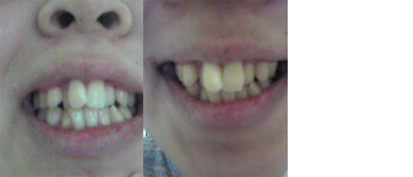 (写真相談) 前歯ががたがたで矯正を検討中。抜歯が