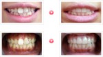 「歯並び」でお悩みの患者様の治療例-01