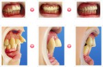 「出っ歯」でお悩みの患者様の治療例-02