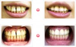 「すきっ歯」でお悩みの患者様の治療例-01