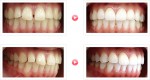 「すきっ歯」でお悩みの患者様の治療例-02