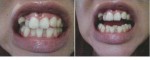 (写真相談) 綺麗な歯並びになりたい、どんな治療、期間と費用は