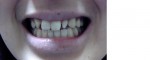 (写真相談)歯のすきま、セラミックを被せる治療,欠点デメリット?