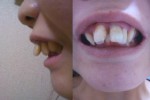 出っ歯とすきっ歯、この歯並びでは舌裏矯正は無理だと言わ