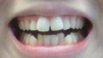 前歯２本が大きく、すきっ歯で出っ歯、親知らず抜歯する？