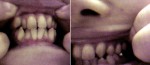 大きい受け口、片側抜歯での矯正、セカンドオピニオン希望