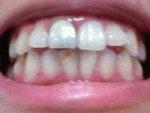 (写真相談)前歯の根元が黒ずんできた、永久的に綺麗な差し歯は？