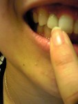 (写真)先日前歯を差し歯に。黄色く見え歯茎が黒く見えて不自然。