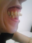 (写真)前歯の矯正ですが方法と概算を教えて。