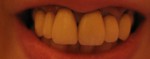 数年前から差し歯の歯茎に金属が見え歯茎の色も変色し