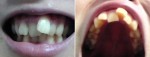 小３年に遊具にぶつかり、前歯一つだけ出て隣の歯が内側