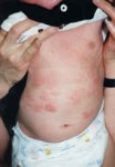乳幼児の湿疹、アトピーの基本的対処法　その３